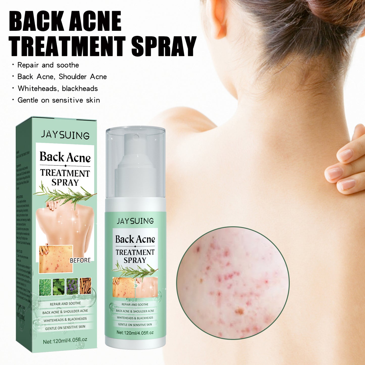 Jaysuing Back Acne Repair Spray, Repair Body Acne Fade Acne Mark Skin Care Spray