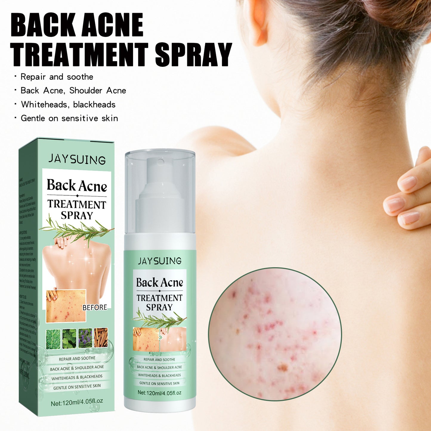 Back Acne Repair Back Shoulder Acne Desalination Acne Mark Skin Care Spray
