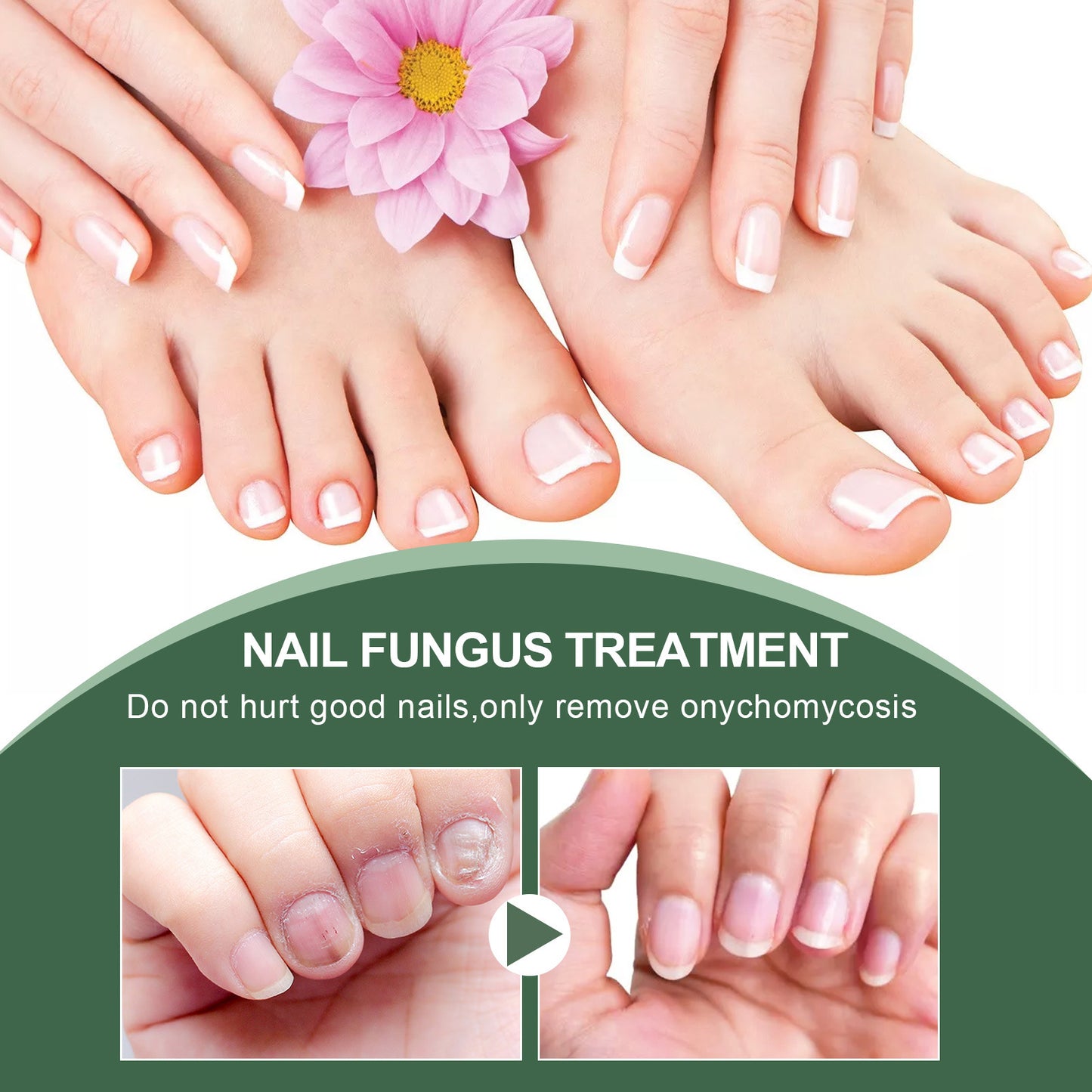 Foot Care Solution Onychomycosis Nail Care Solution