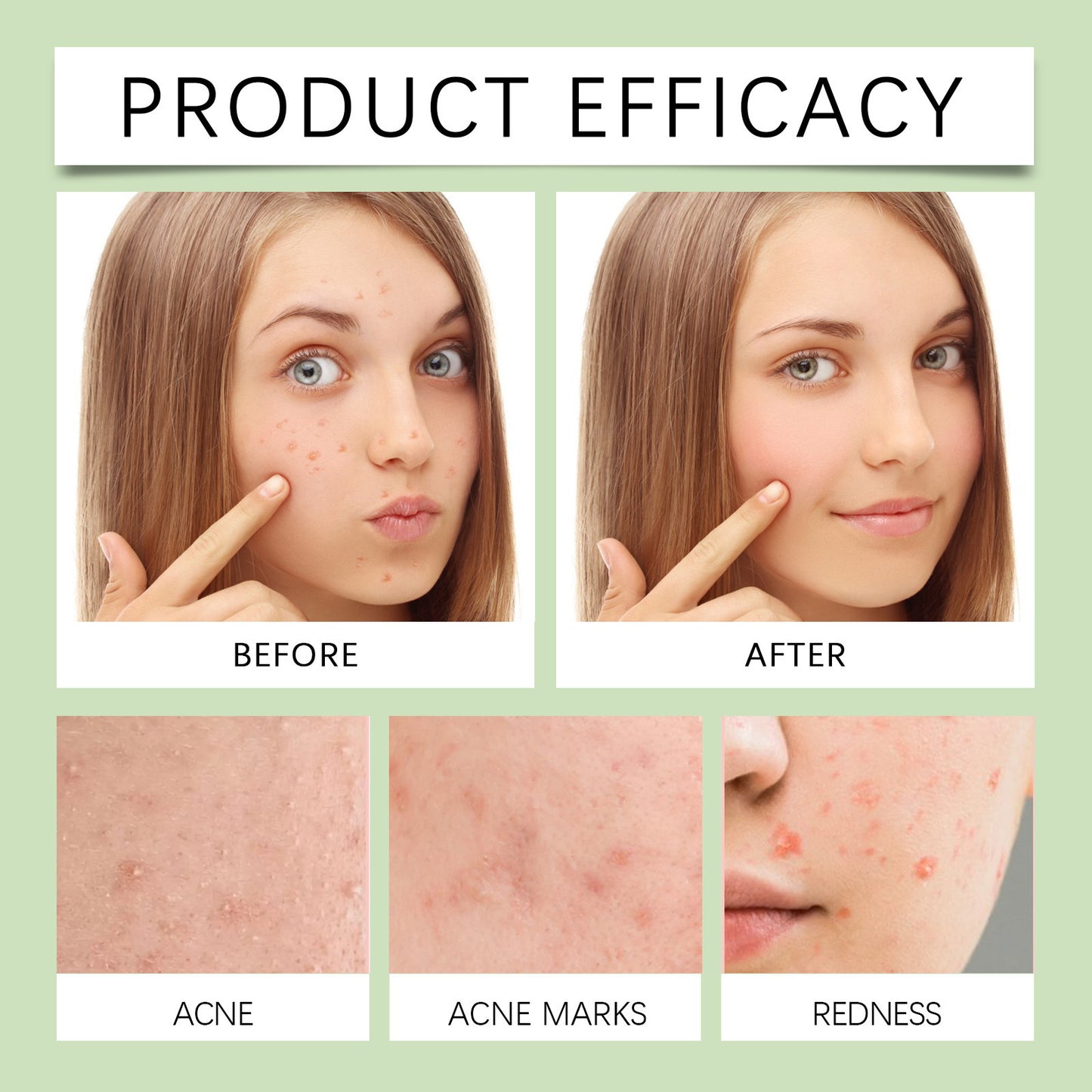 Acne Miracle Patch Removes Pimples Skin Care